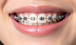 Diş Teli Fiyatları 2025: En Ekonomik Tedavi Hangisi?