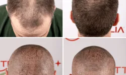 Hair Transplant Antalya