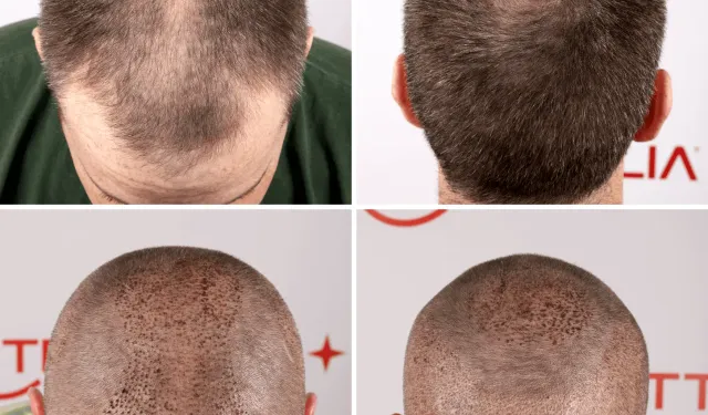 Hair Transplant Antalya