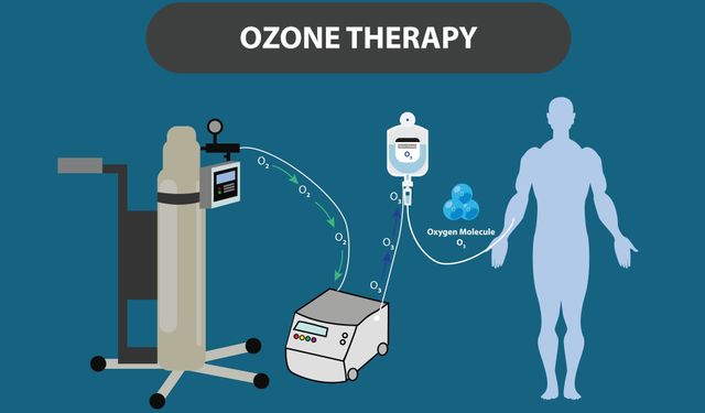Ozon Tedavisi Nedir? Faydaları Nelerdir?