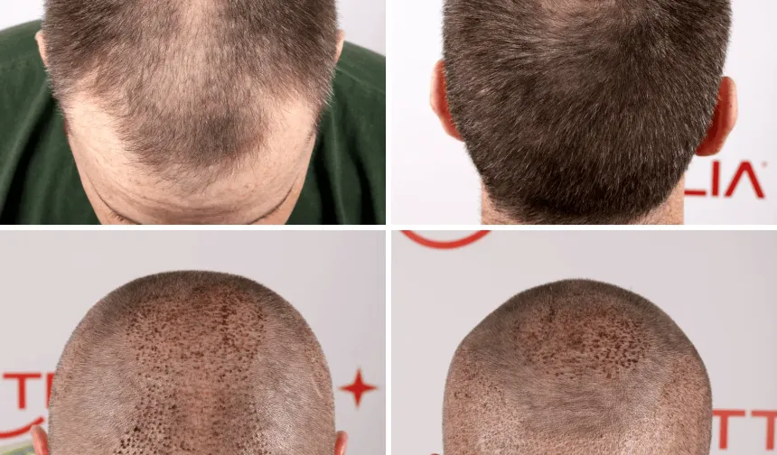Hair Transplant Antalya